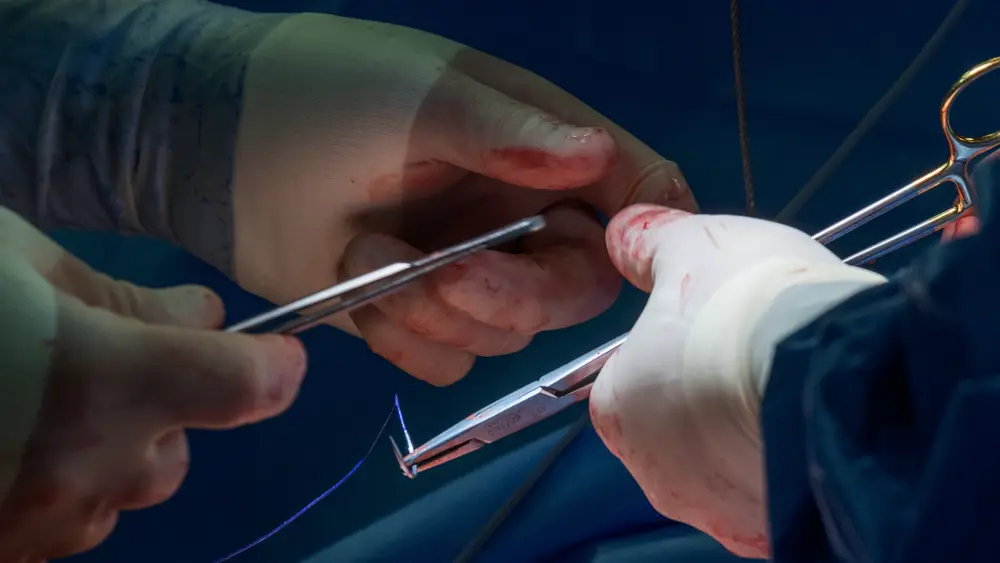 Cover of the book “Minimally‑Invasive Coronary Artery Bypass Surgery”