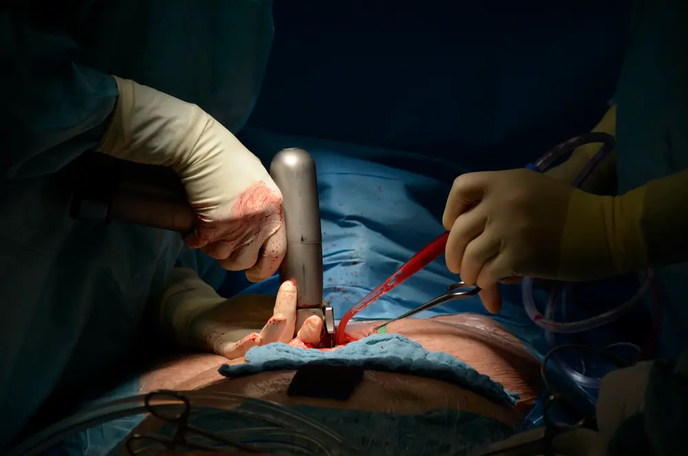 Open heart surgery photo 0004